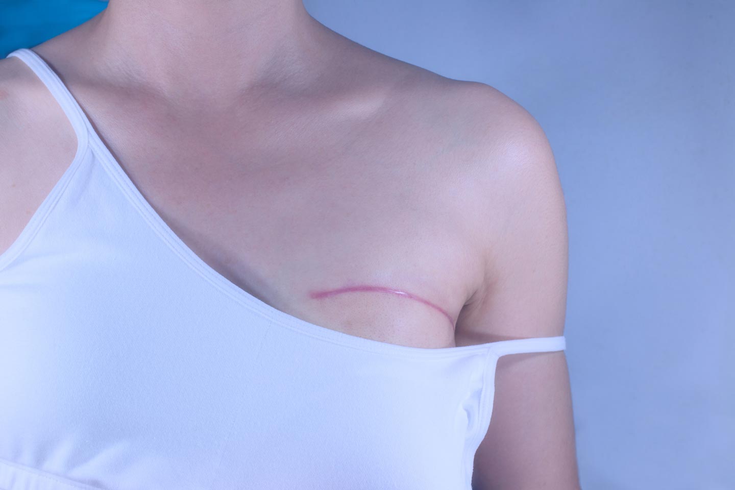 Biotin can help build a possible alternative to synthetic breast implants.